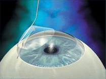 LASIK Femtoseconde 3