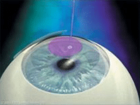 LASIK Femtoseconde 4