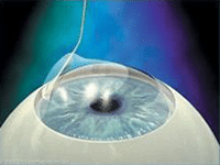 LASIK Femtoseconde 5