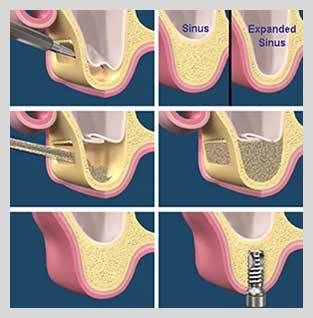 sinus lift augmentation