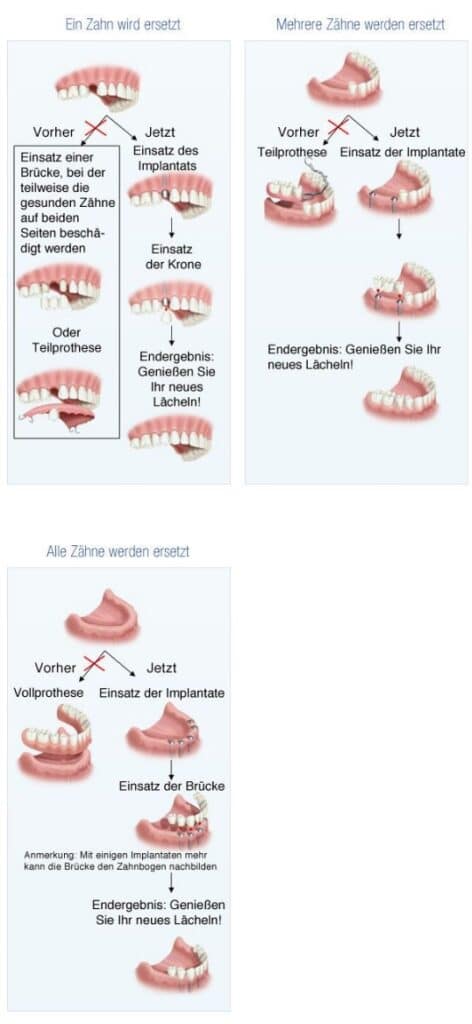 Phasen der Zahnimplantation