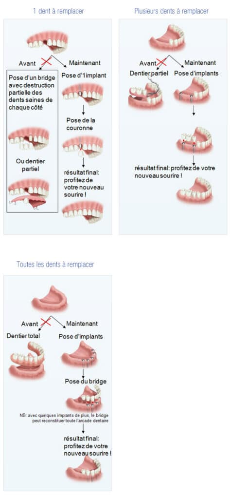 Phases pose implant dentaire