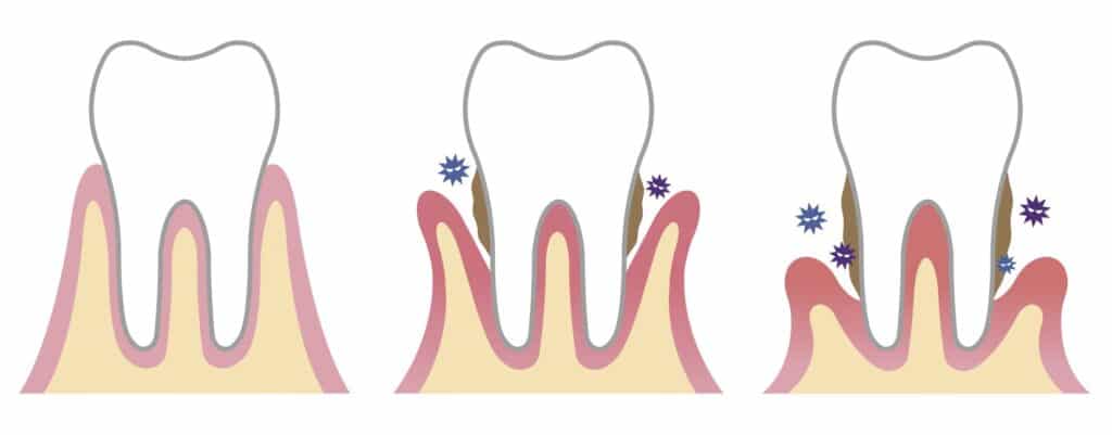 Stades de la parodontite
