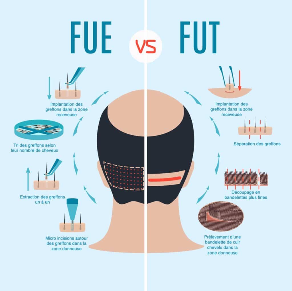 FUE vs FUT