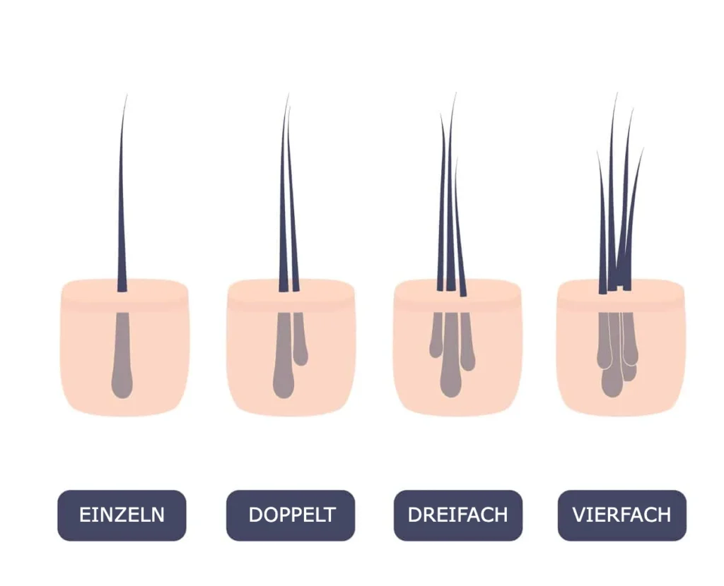 Greffons greffe de cheveux