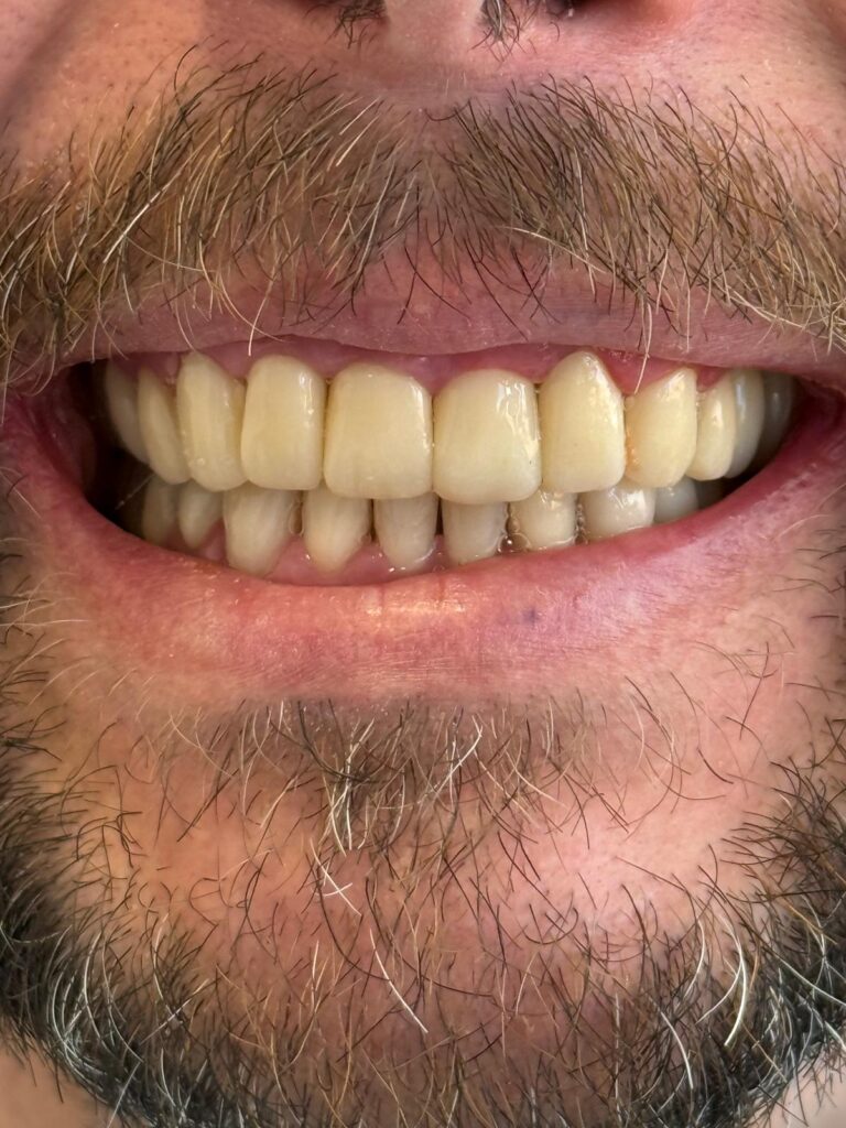 implants dentaires et couronnes - après