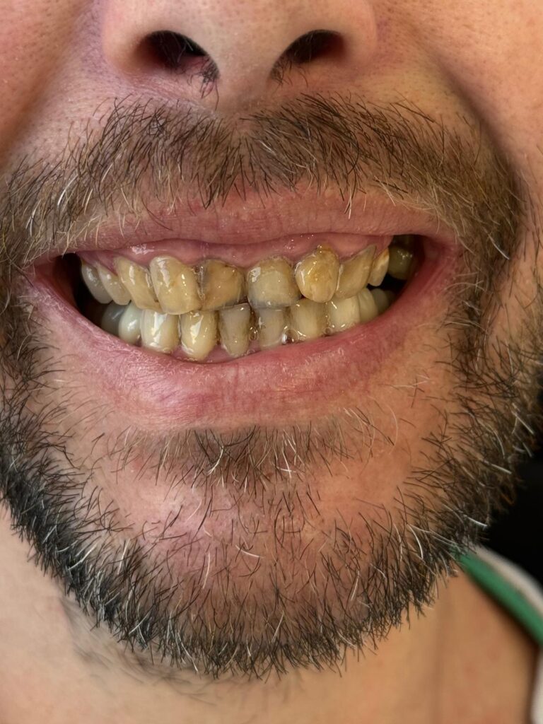 implants dentaires et couronnes - avant