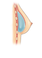 Augmentation mammaire dual plane